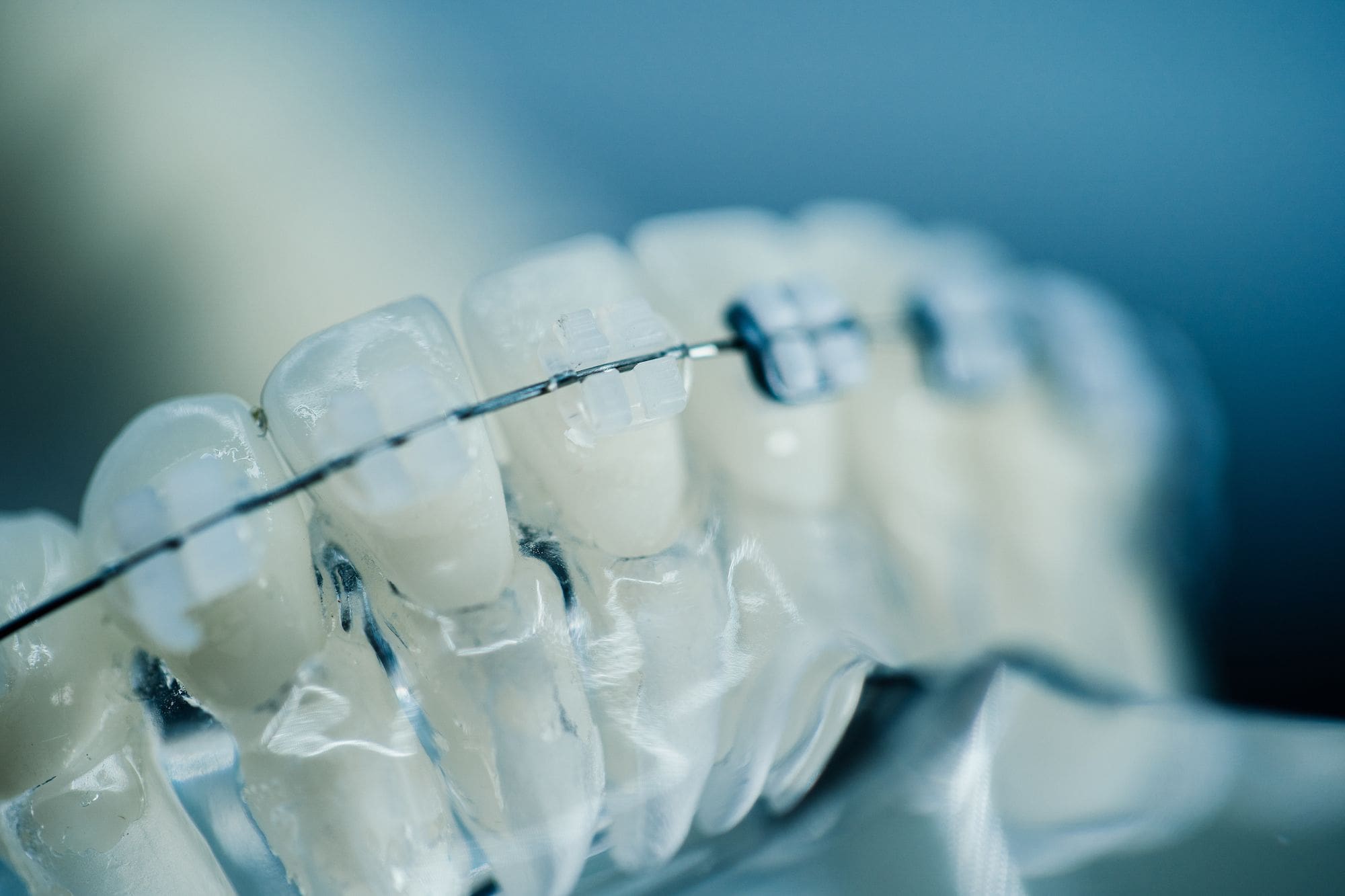 38,405 Orthodontics Braces In Mouth Images, Stock Photos, 3D objects, &  Vectors | Shutterstock